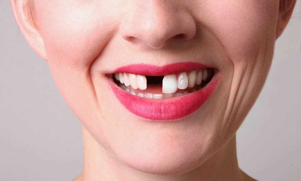 活动临时假牙套遮盖牙齿贴面片大门牙隐形义齿可拆卸超薄缺牙自补