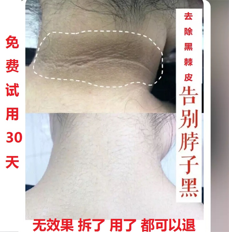 脖子黑洗不干净去除后颈黑色素黑棘皮美白霜颈部腋下沉淀大腿根部