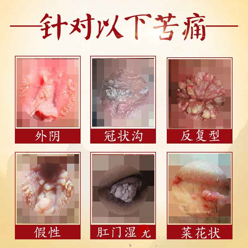 祛尖锐疣湿疣男女性软膏防复发丝状疣鬼臼毒肛门寻常假性检测hpv