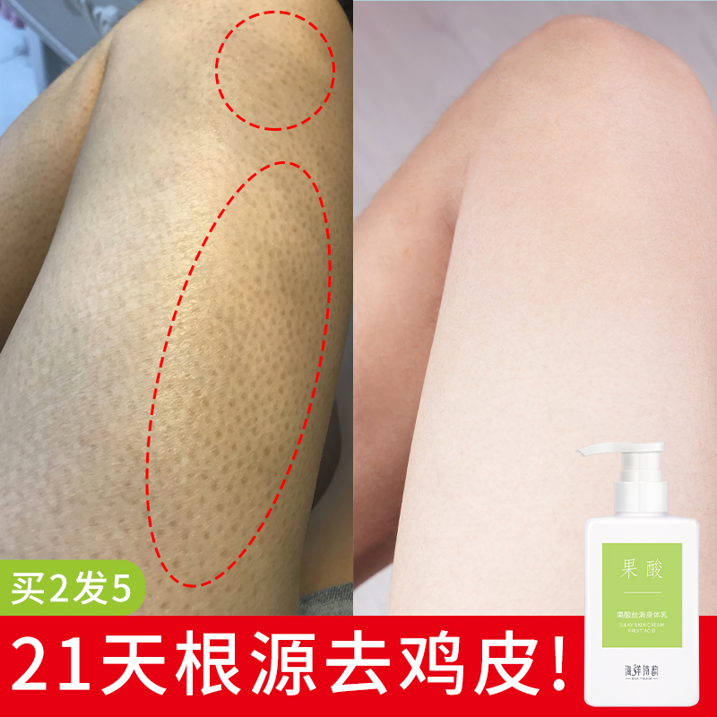果酸身体乳女去鸡皮肤疙瘩毛囊角质角化膏腿部祛蛇皮鱼鳞去除神器
