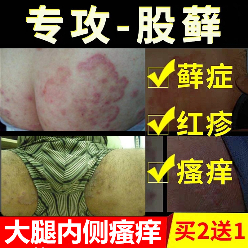 皮肤止痒膏大腿内侧瘙痒儿童湿毒红疹手足干痒脱皮成人阴囊湿痒膏