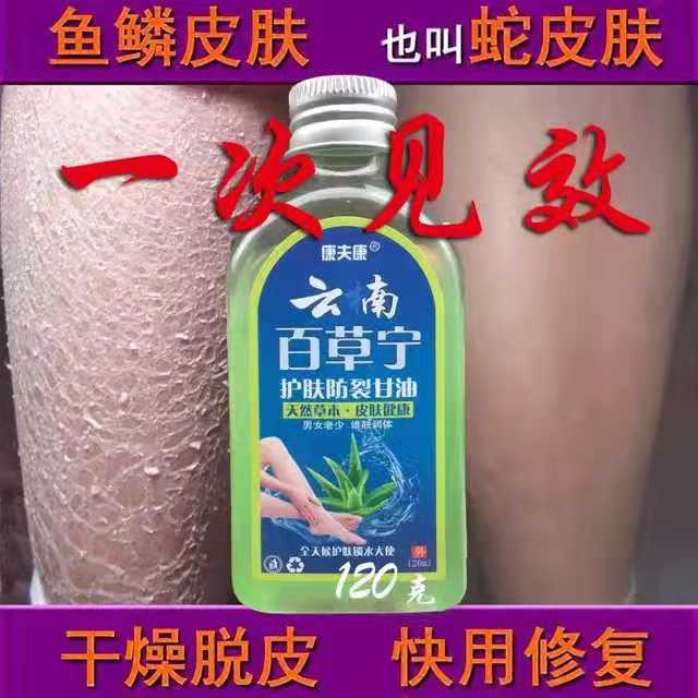 鱼鳞皮肤霜蛇皮肤去干燥脱皮干裂鸡全身毛周角化保湿补水病身体乳