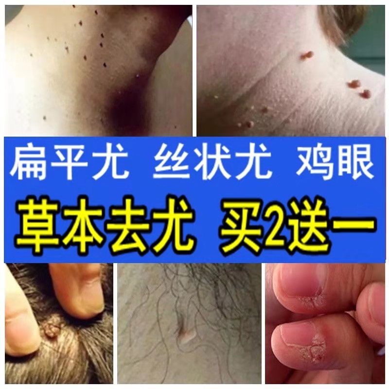 丝状疣脖子颈部皮赘肉刺膏瘊子体私处尤立净灵克疣液腋下去除肉粒