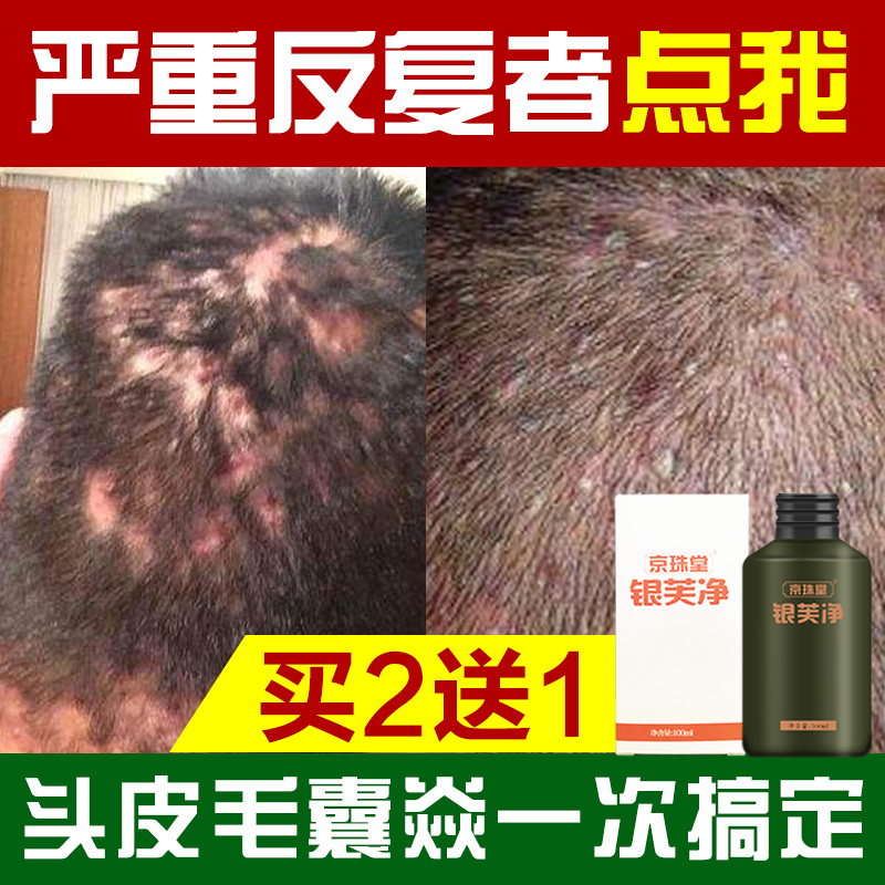 共73 件头皮毛囊炎脓包相关商品