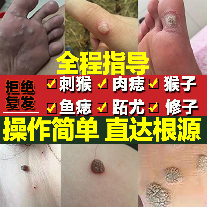 去猴子的药肉刺猴去除正品瘊子膏手部足部脚底鱼鳞痣贴