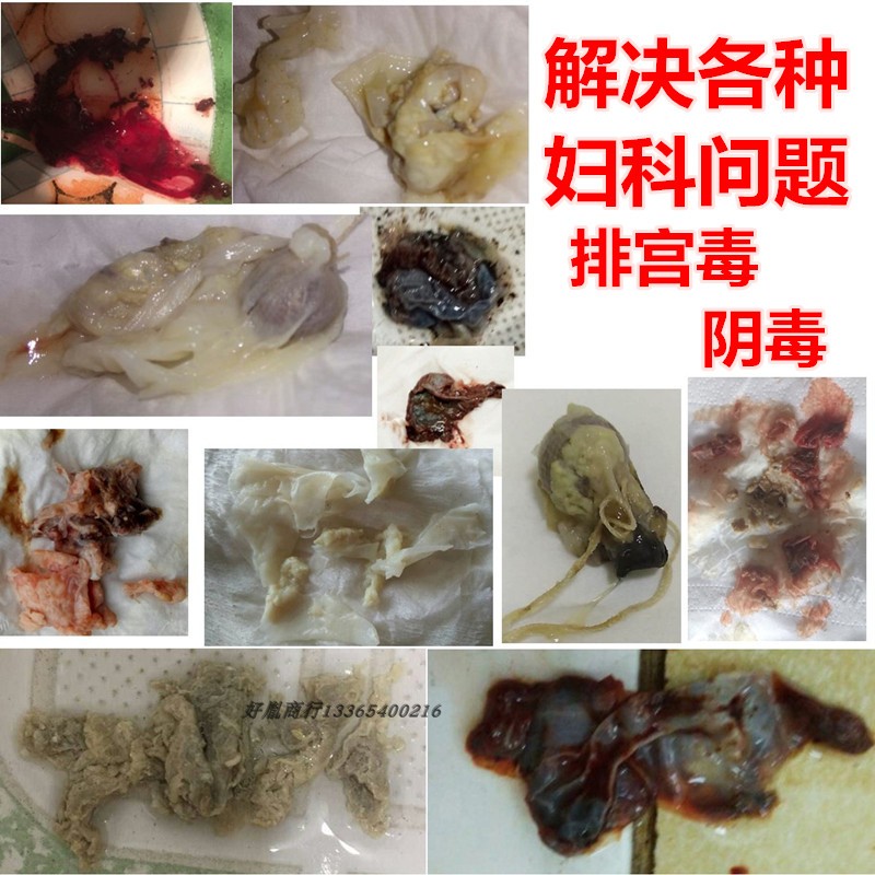 妇科清宫拉线丸私处护理紧致排du异味霉菌滴虫宫糜消1粒正品包邮